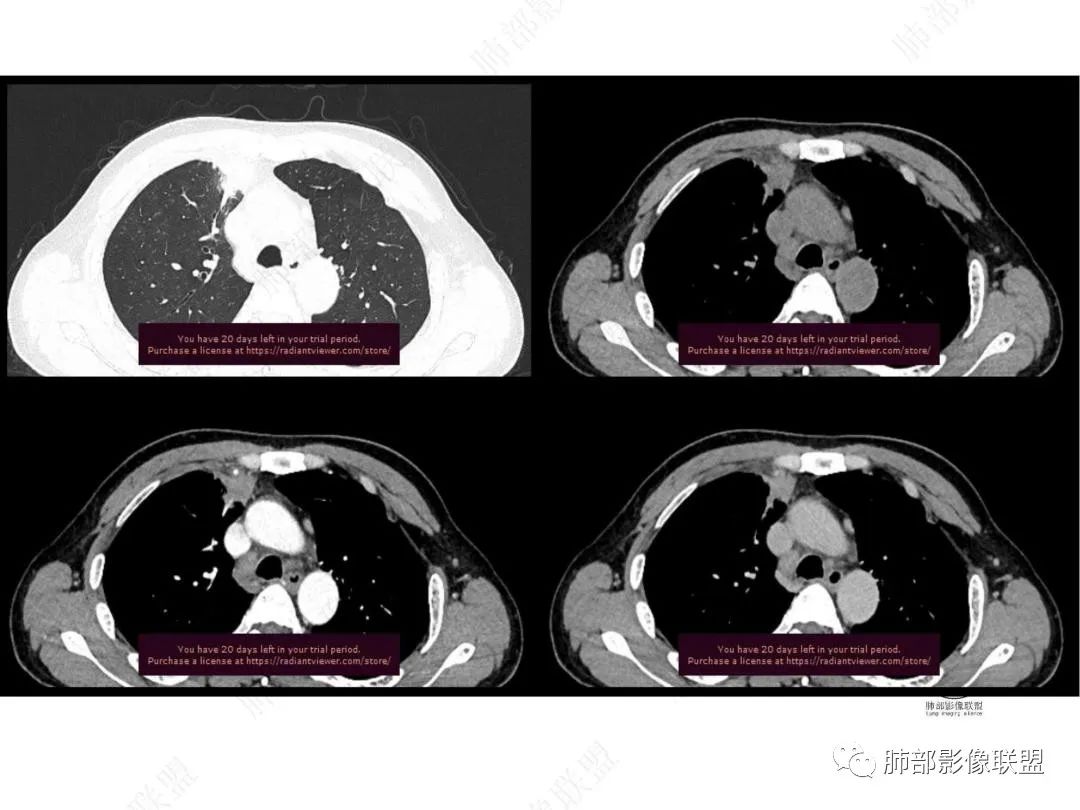 影像PPT - 【病例】右肺与肝脏病灶来袭,是否同源?-22 影像PPT - 【病例】右肺与肝脏病灶来袭,是否同源?-22