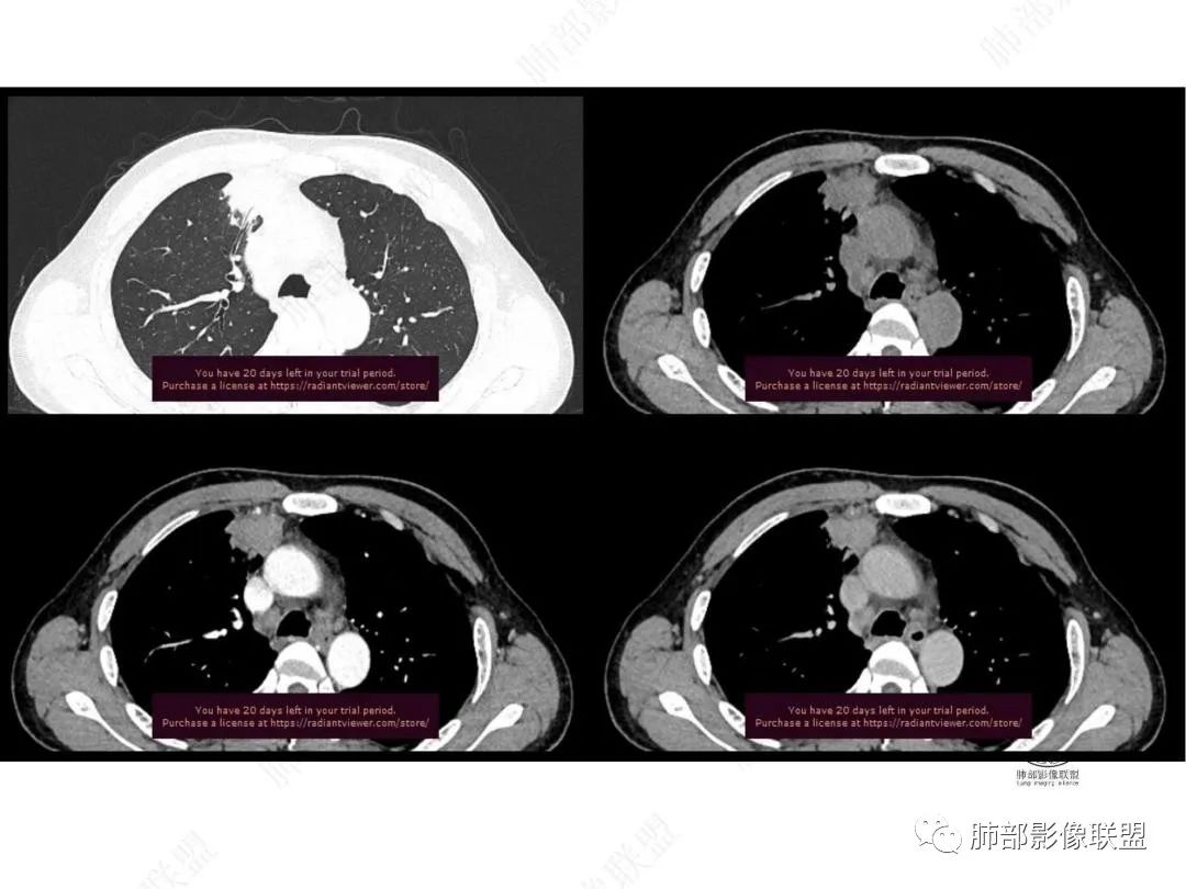影像PPT - 【病例】右肺与肝脏病灶来袭,是否同源?-23 影像PPT - 【病例】右肺与肝脏病灶来袭,是否同源?-23