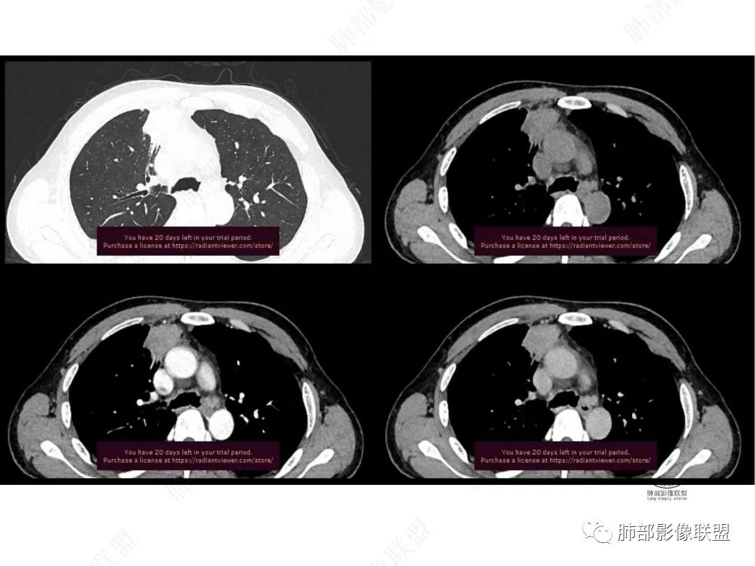 影像PPT - 【病例】右肺与肝脏病灶来袭,是否同源?-24 影像PPT - 【病例】右肺与肝脏病灶来袭,是否同源?-24