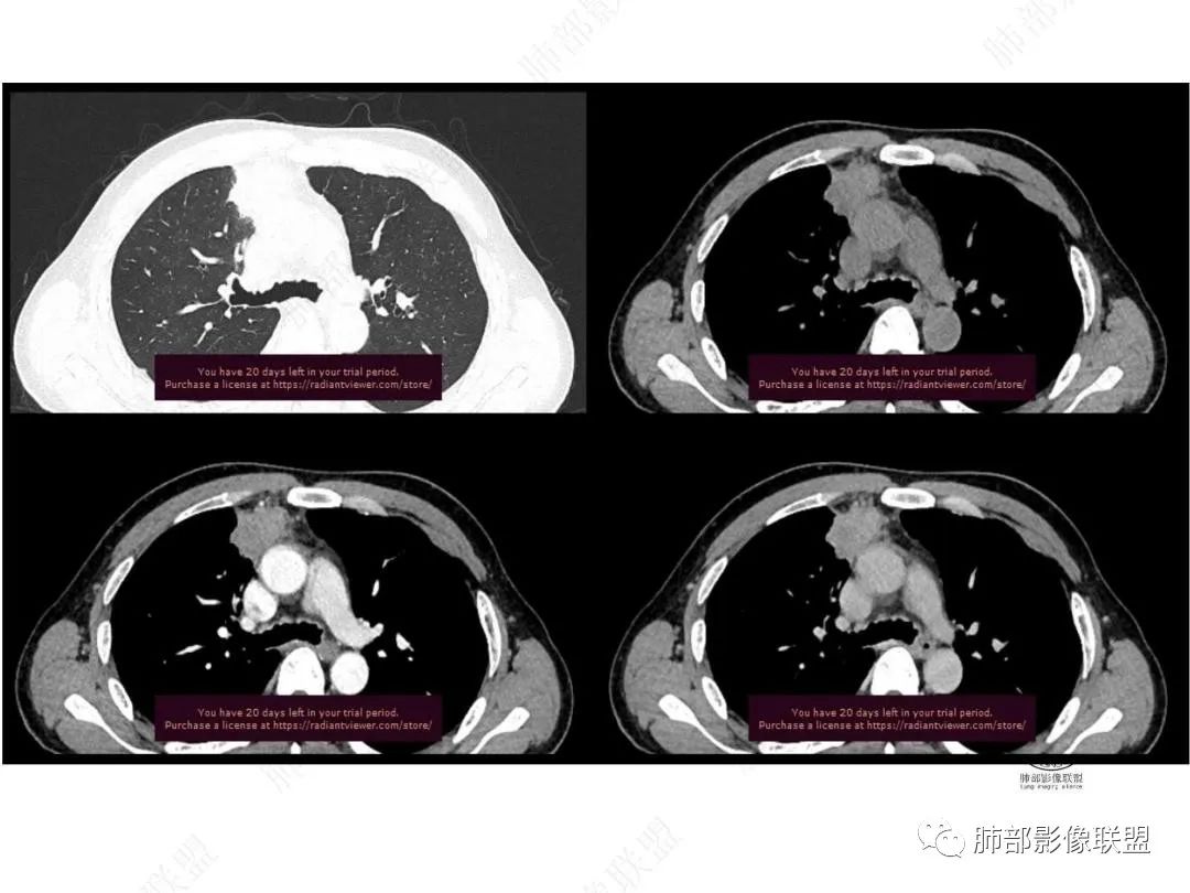 影像PPT - 【病例】右肺与肝脏病灶来袭,是否同源?-25 影像PPT - 【病例】右肺与肝脏病灶来袭,是否同源?-25