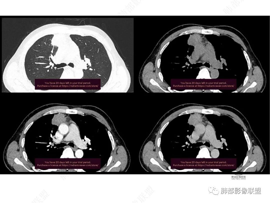 影像PPT - 【病例】右肺与肝脏病灶来袭,是否同源?-26 影像PPT - 【病例】右肺与肝脏病灶来袭,是否同源?-26