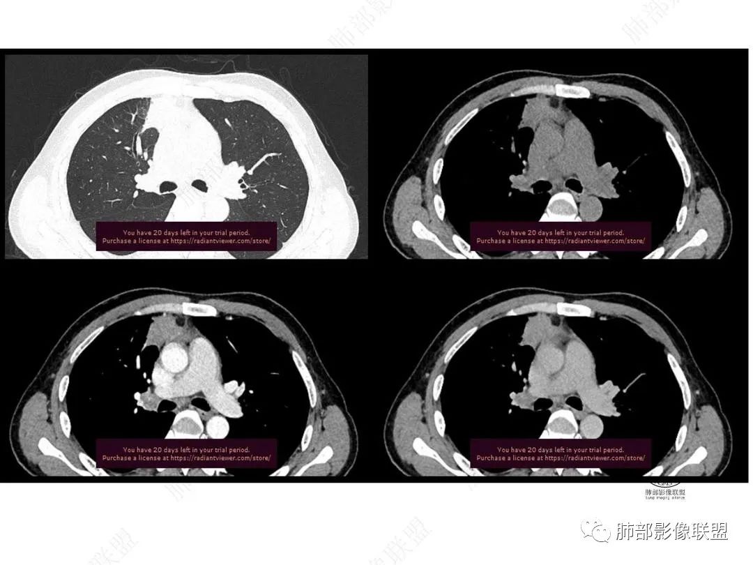 影像PPT - 【病例】右肺与肝脏病灶来袭,是否同源?-27 影像PPT - 【病例】右肺与肝脏病灶来袭,是否同源?-27