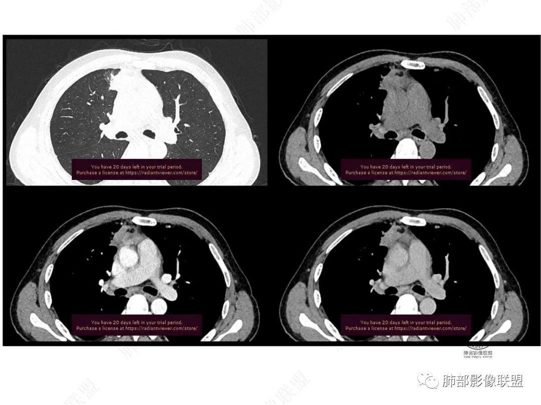影像PPT - 【病例】右肺与肝脏病灶来袭,是否同源?-28 影像PPT - 【病例】右肺与肝脏病灶来袭,是否同源?-28