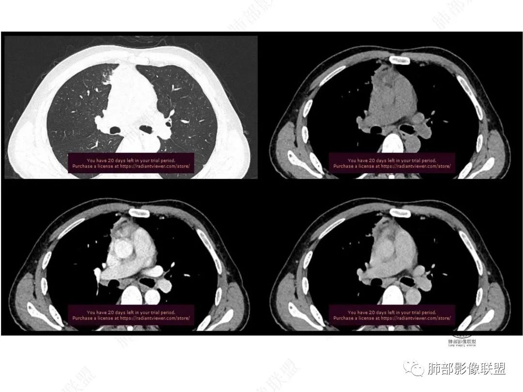 影像PPT - 【病例】右肺与肝脏病灶来袭,是否同源?-29 影像PPT - 【病例】右肺与肝脏病灶来袭,是否同源?-29