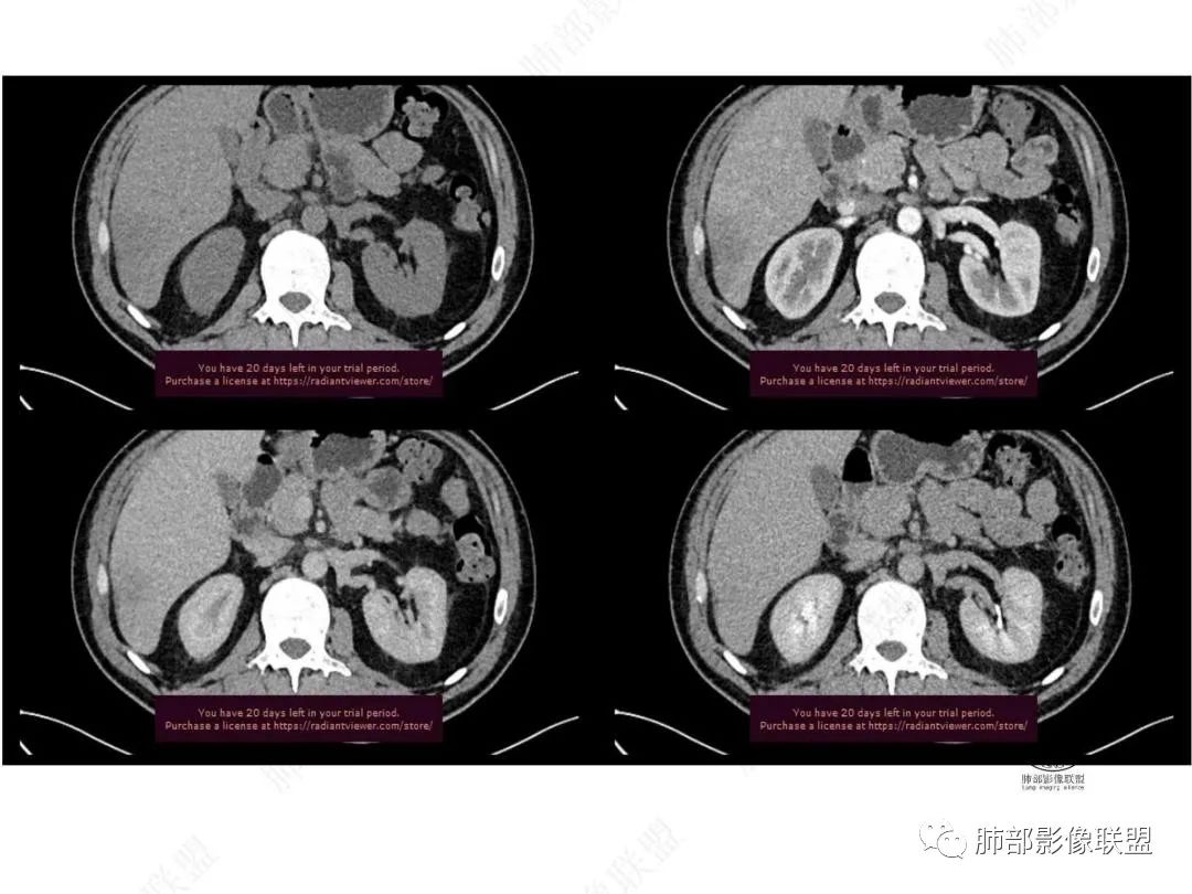 影像PPT - 【病例】右肺与肝脏病灶来袭,是否同源?-30 影像PPT - 【病例】右肺与肝脏病灶来袭,是否同源?-30