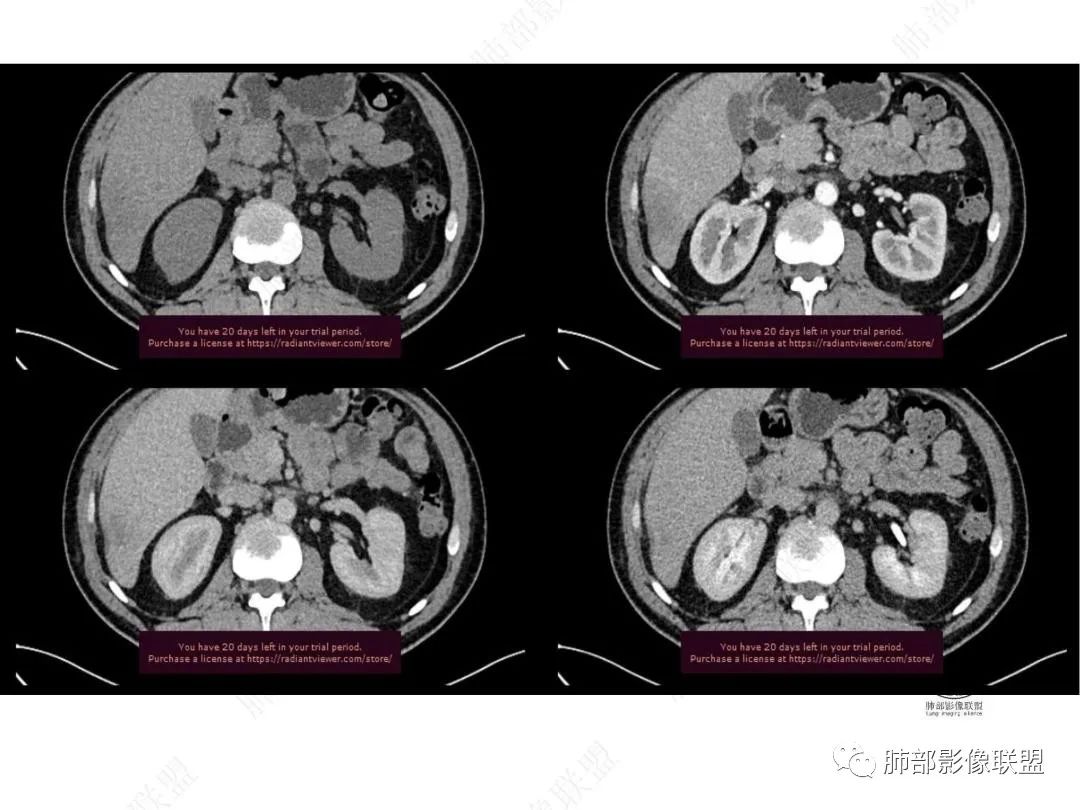 影像PPT - 【病例】右肺与肝脏病灶来袭,是否同源?-31 影像PPT - 【病例】右肺与肝脏病灶来袭,是否同源?-31