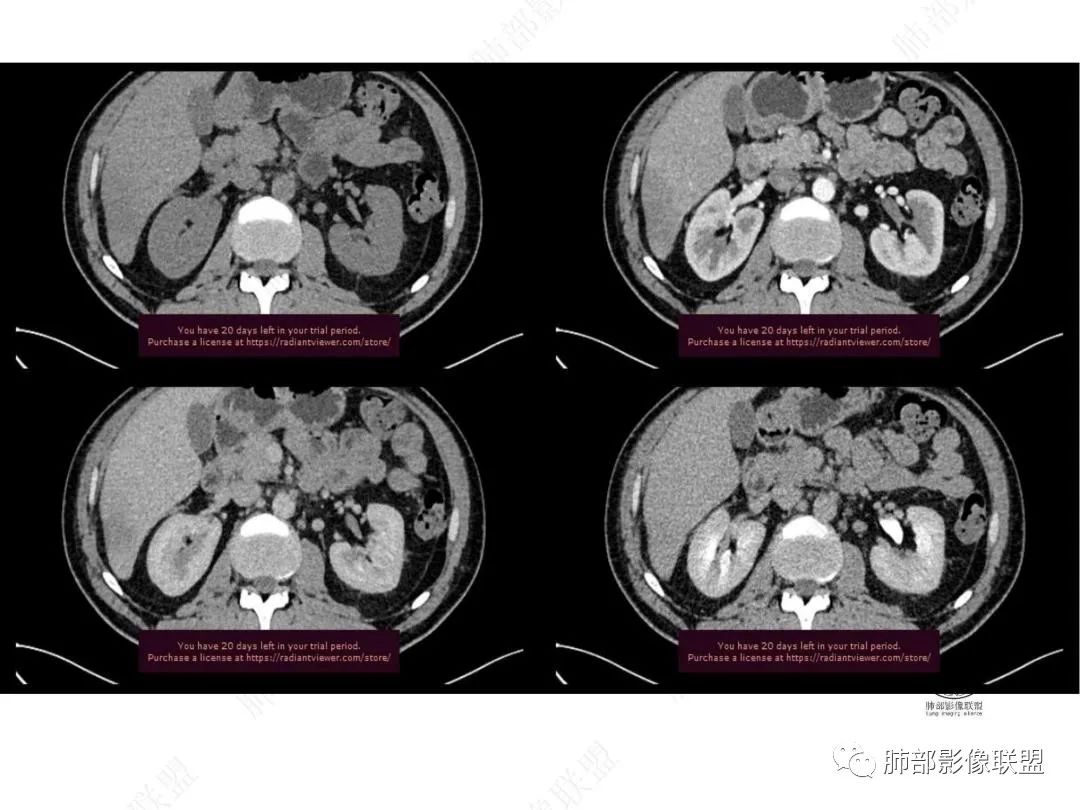 影像PPT - 【病例】右肺与肝脏病灶来袭,是否同源?-32 影像PPT - 【病例】右肺与肝脏病灶来袭,是否同源?-32