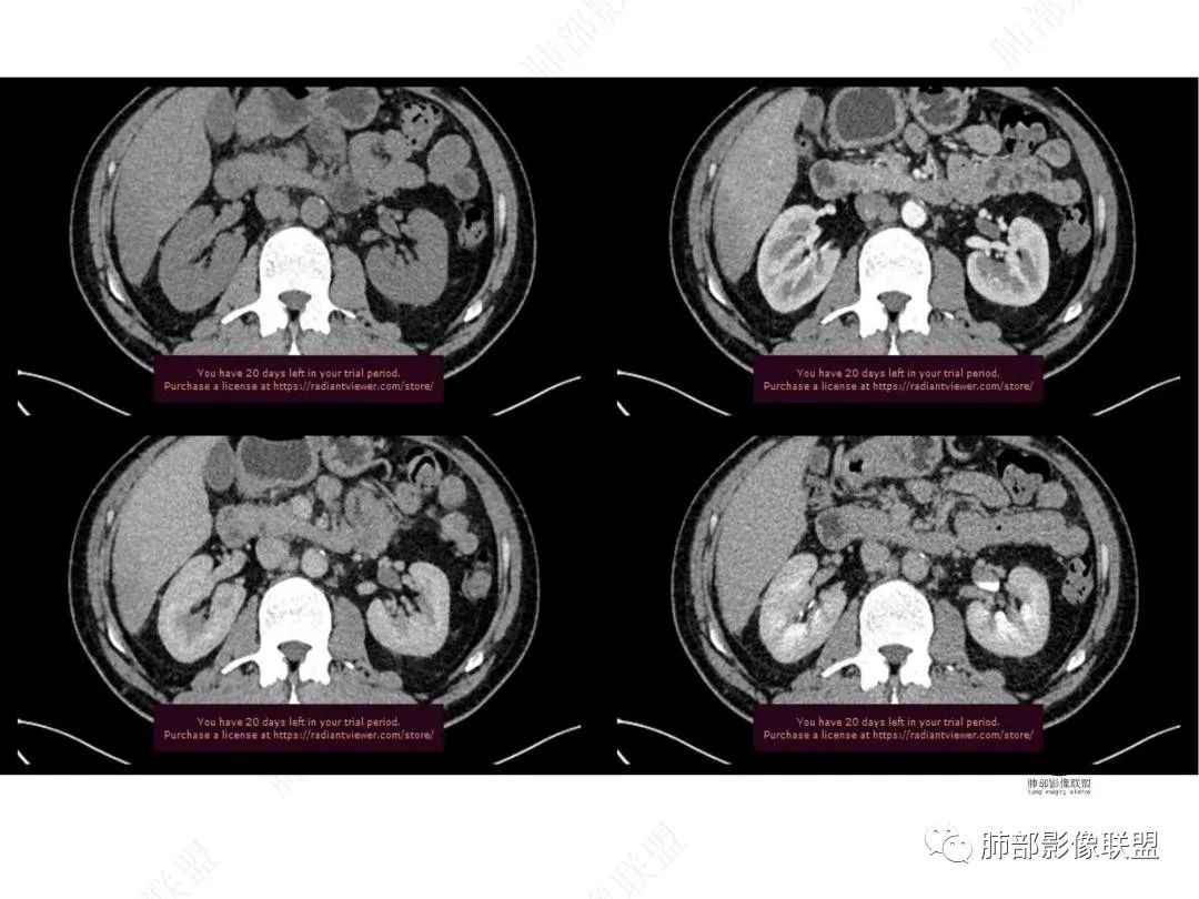 影像PPT - 【病例】右肺与肝脏病灶来袭,是否同源?-33 影像PPT - 【病例】右肺与肝脏病灶来袭,是否同源?-33