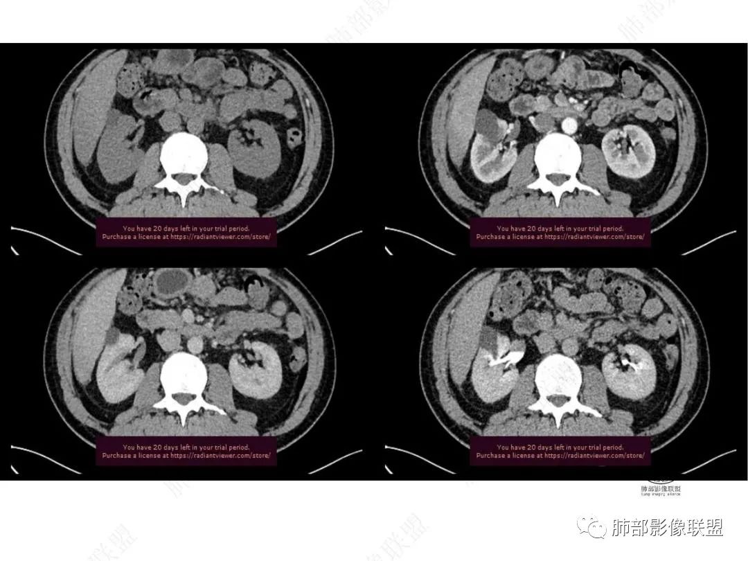 影像PPT - 【病例】右肺与肝脏病灶来袭,是否同源?-34 影像PPT - 【病例】右肺与肝脏病灶来袭,是否同源?-34