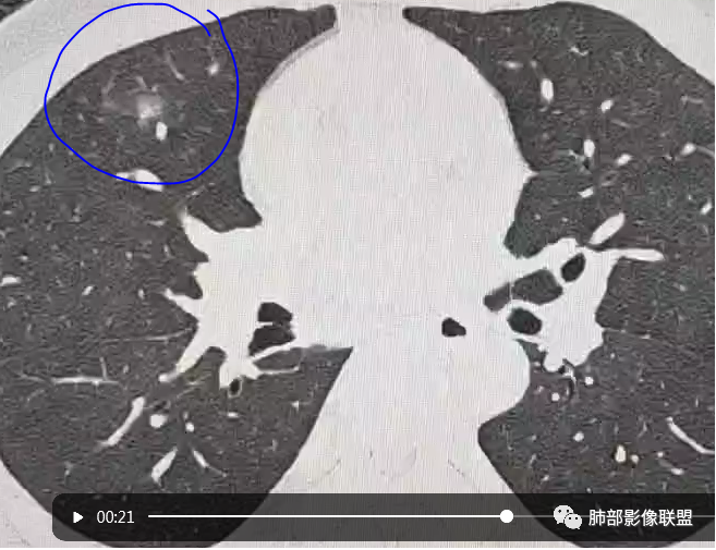 影像PPT - 【病例】右肺与肝脏病灶来袭,是否同源?-41 影像PPT - 【病例】右肺与肝脏病灶来袭,是否同源?-41