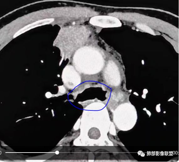 影像PPT - 【病例】右肺与肝脏病灶来袭,是否同源?-43 影像PPT - 【病例】右肺与肝脏病灶来袭,是否同源?-43