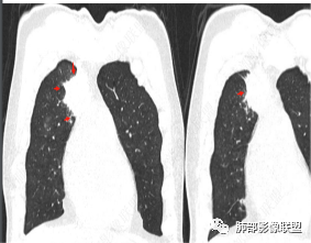 影像PPT - 【病例】右肺与肝脏病灶来袭,是否同源?-51 影像PPT - 【病例】右肺与肝脏病灶来袭,是否同源?-51