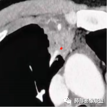 影像PPT - 【病例】右肺与肝脏病灶来袭,是否同源?-53 影像PPT - 【病例】右肺与肝脏病灶来袭,是否同源?-53