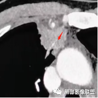 影像PPT - 【病例】右肺与肝脏病灶来袭,是否同源?-54 影像PPT - 【病例】右肺与肝脏病灶来袭,是否同源?-54