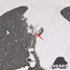 影像PPT - 【病例】右肺与肝脏病灶来袭,是否同源?-58 影像PPT - 【病例】右肺与肝脏病灶来袭,是否同源?-58