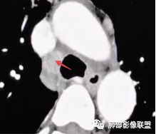 影像PPT - 【病例】右肺与肝脏病灶来袭,是否同源?-61 影像PPT - 【病例】右肺与肝脏病灶来袭,是否同源?-61
