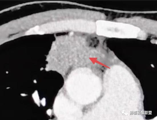 影像PPT - 【病例】右肺与肝脏病灶来袭,是否同源?-62 影像PPT - 【病例】右肺与肝脏病灶来袭,是否同源?-62
