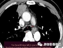 影像PPT - 【病例】右肺与肝脏病灶来袭,是否同源?-63 影像PPT - 【病例】右肺与肝脏病灶来袭,是否同源?-63