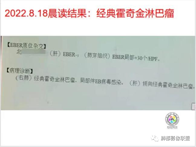 影像PPT - 【病例】右肺与肝脏病灶来袭,是否同源?-66 影像PPT - 【病例】右肺与肝脏病灶来袭,是否同源?-66