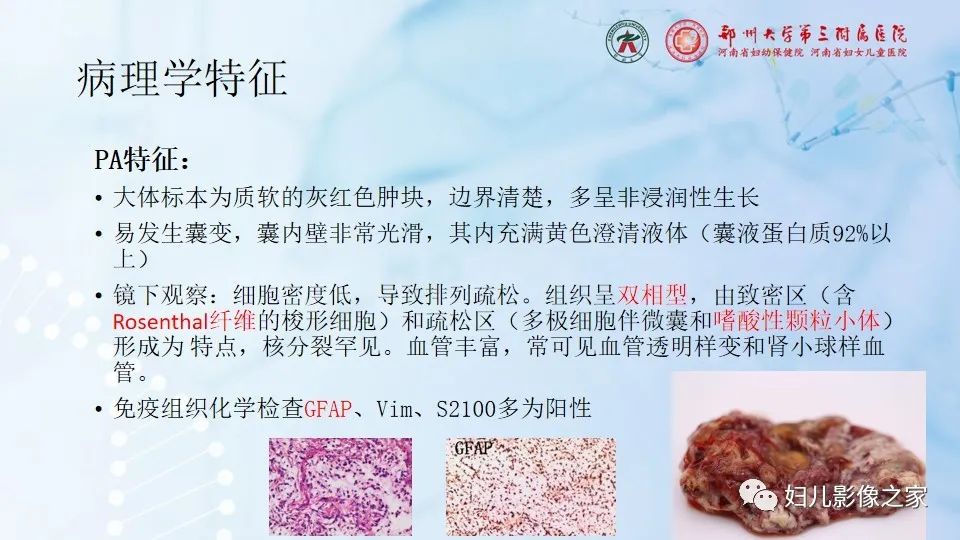 影像PPT - 【病例】毛细胞型星形细胞瘤1例CT及MR-16