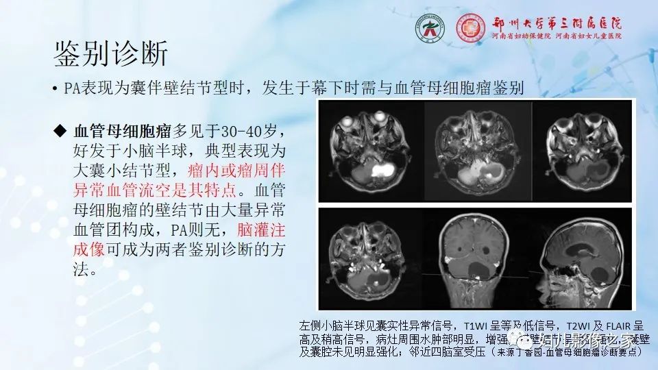 影像PPT - 【病例】毛细胞型星形细胞瘤1例CT及MR-22
