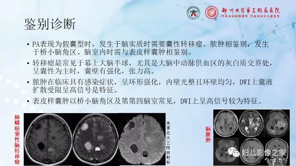 影像PPT - 【病例】毛细胞型星形细胞瘤1例CT及MR-24