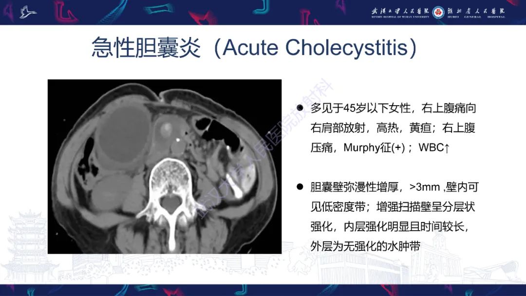 影像PPT - 【PPT】胆囊壁增厚影像鉴别诊断-7