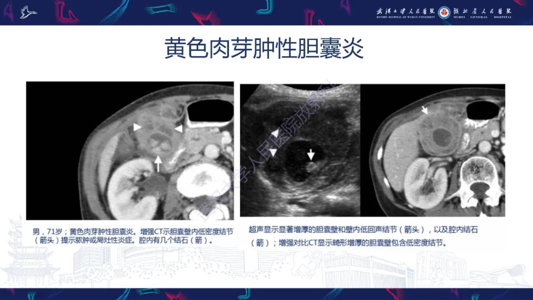 影像PPT - 【PPT】胆囊壁增厚影像鉴别诊断-14