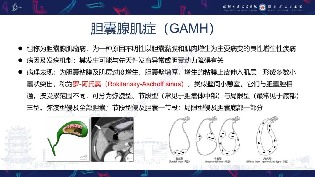 影像PPT - 【PPT】胆囊壁增厚影像鉴别诊断-15