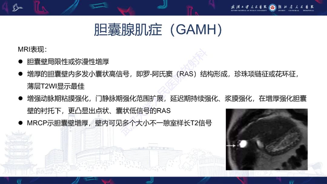 影像PPT - 【PPT】胆囊壁增厚影像鉴别诊断-17