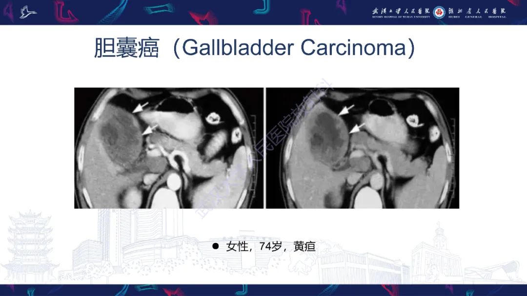 影像PPT - 【PPT】胆囊壁增厚影像鉴别诊断-22