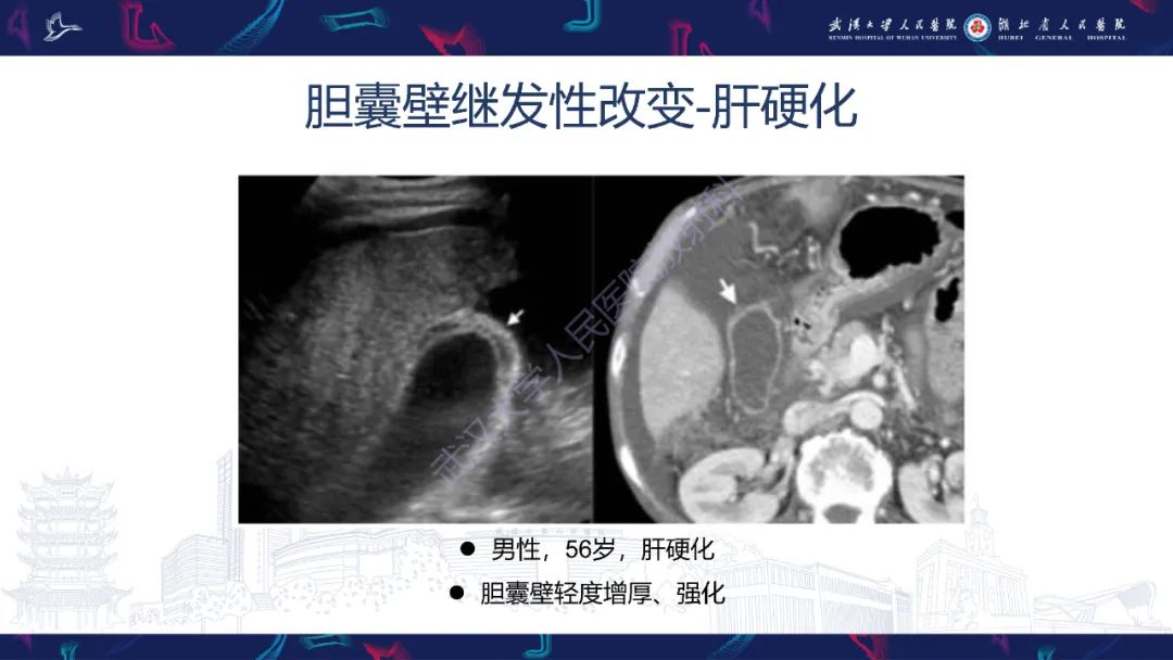 影像PPT - 【PPT】胆囊壁增厚影像鉴别诊断-25