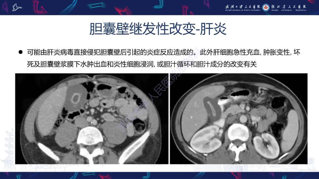 影像PPT - 【PPT】胆囊壁增厚影像鉴别诊断-26