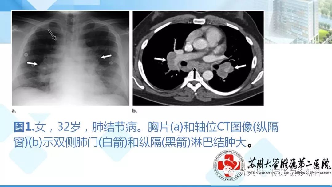 影像PPT - 【PPT】结节病-6