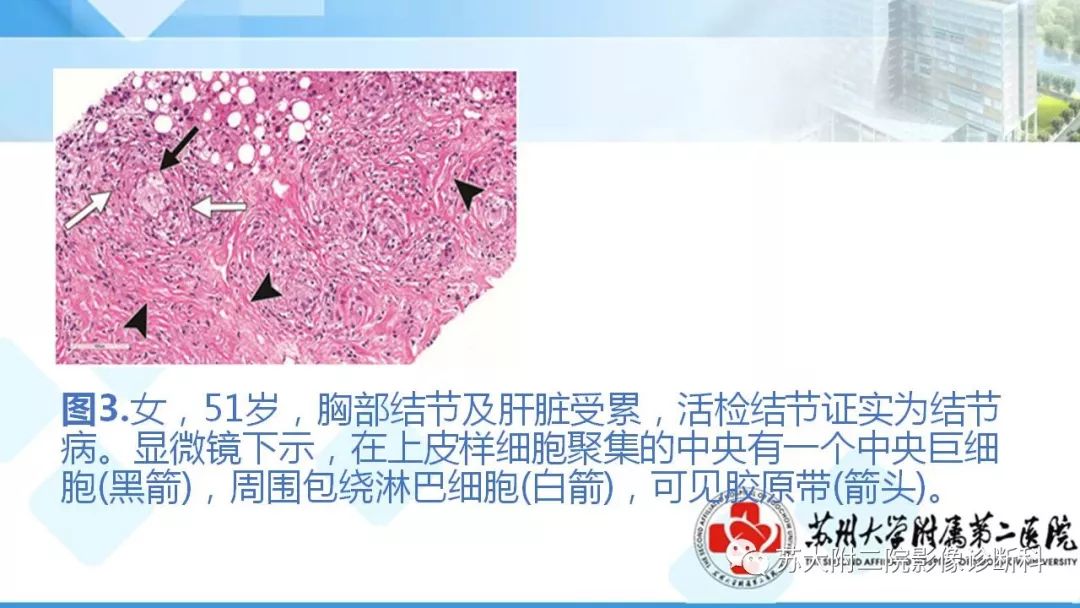影像PPT - 【PPT】结节病-8