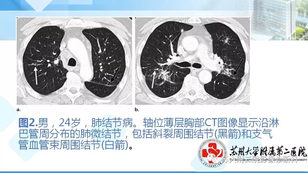 影像PPT - 【PPT】结节病-7