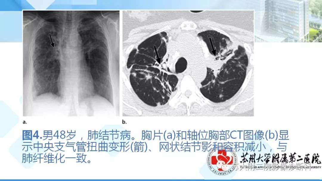 影像PPT - 【PPT】结节病-9