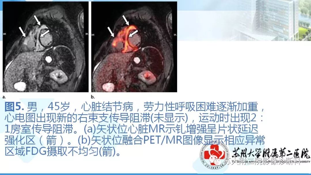 影像PPT - 【PPT】结节病-12