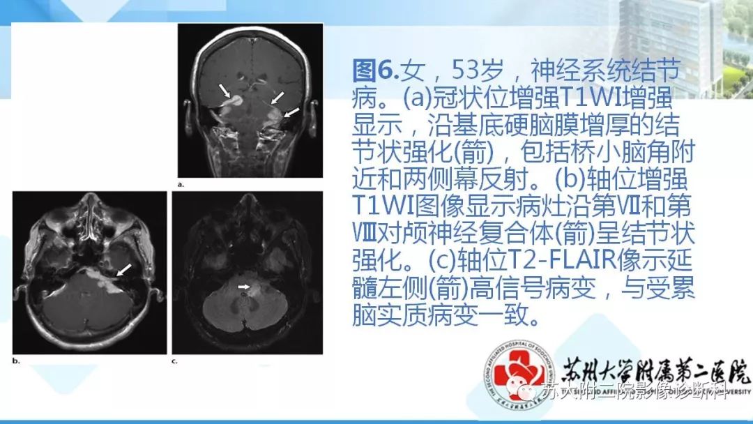 影像PPT - 【PPT】结节病-15