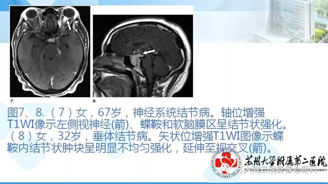 影像PPT - 【PPT】结节病-16