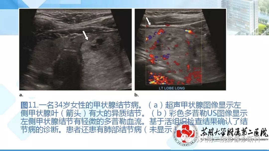 影像PPT - 【PPT】结节病-19
