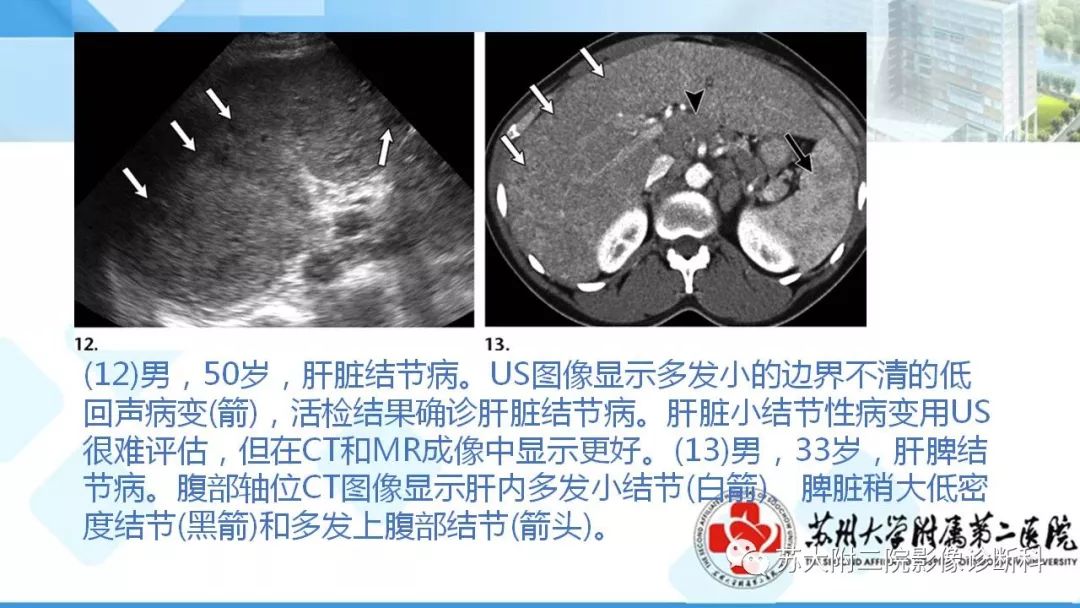 影像PPT - 【PPT】结节病-21