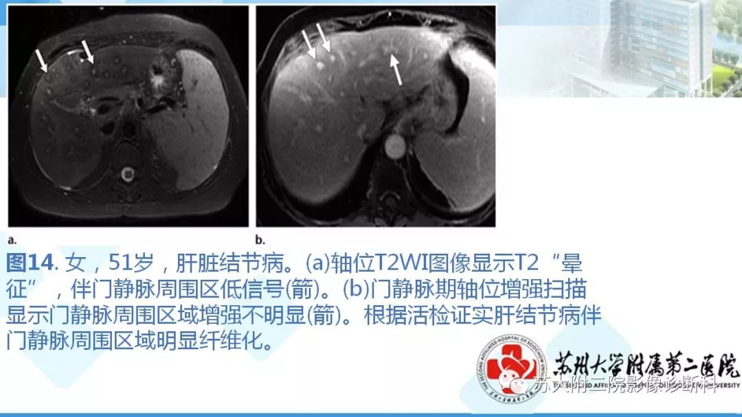 影像PPT - 【PPT】结节病-22
