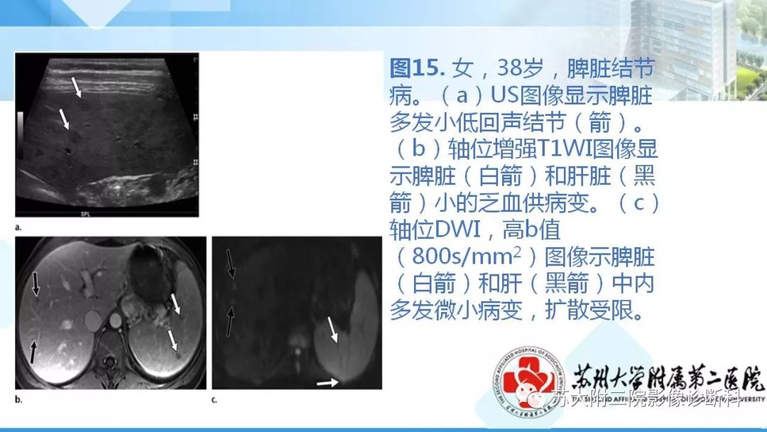 影像PPT - 【PPT】结节病-23