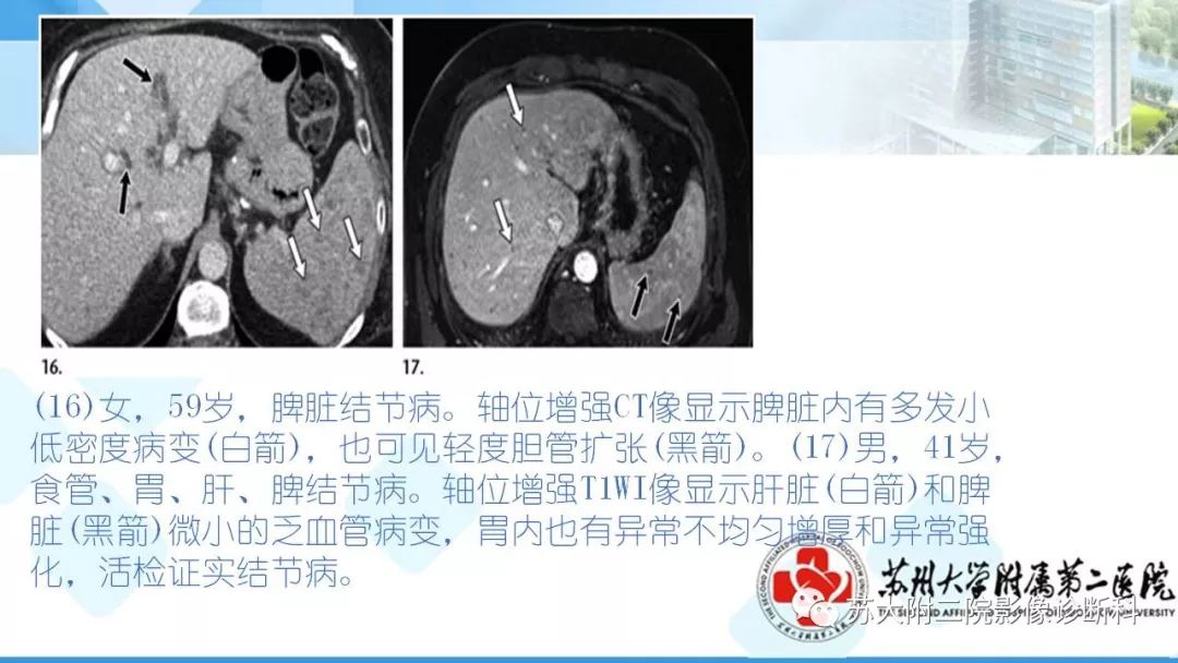 影像PPT - 【PPT】结节病-24