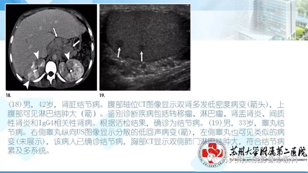 影像PPT - 【PPT】结节病-25