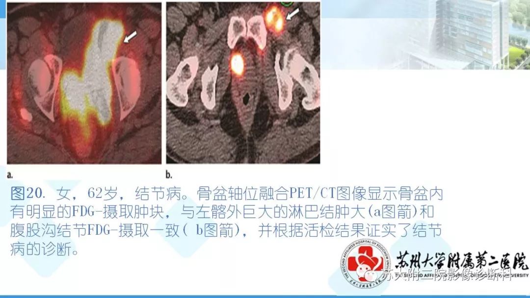 影像PPT - 【PPT】结节病-26