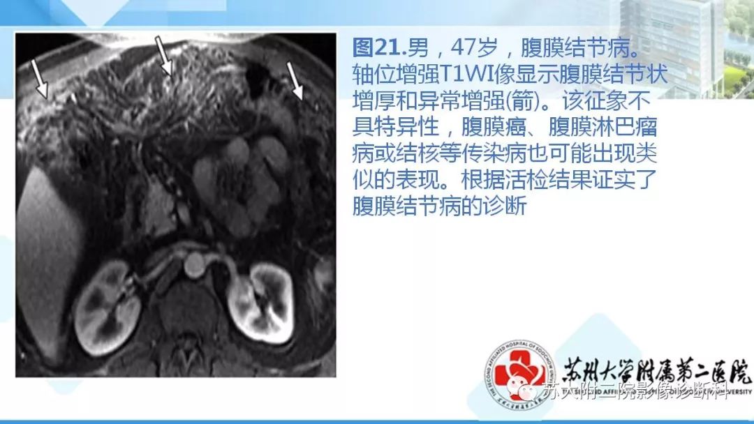 影像PPT - 【PPT】结节病-27