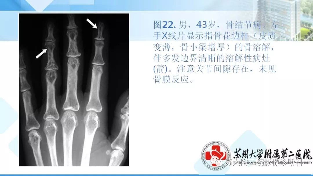影像PPT - 【PPT】结节病-29