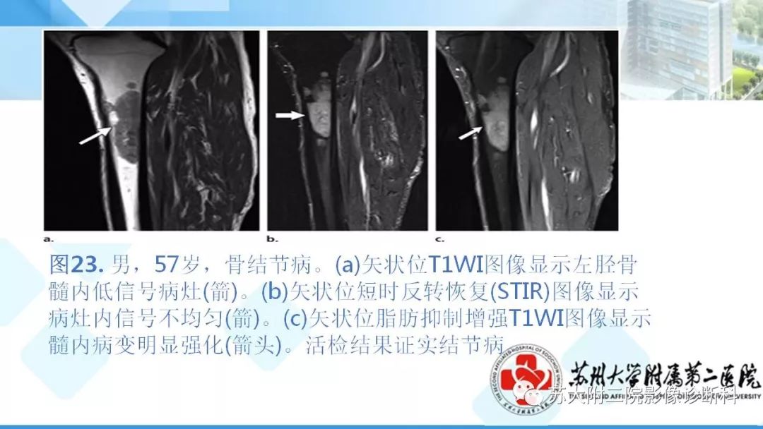 影像PPT - 【PPT】结节病-30